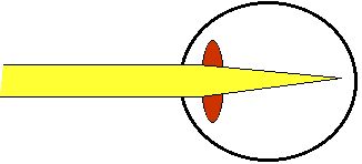 Tekening van bijziend oog dat in de verte kijkt